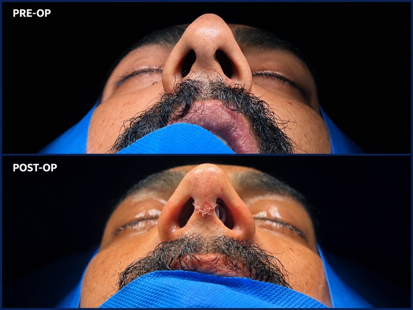 @Rhinoplastyhub clinic222