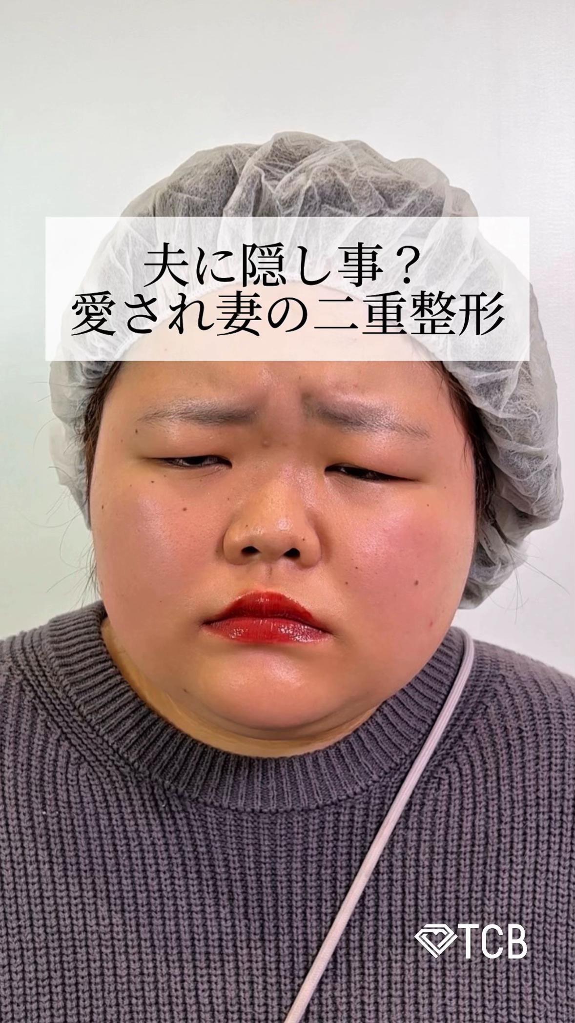 @【二重整形】TCB 新宿東口院ゆいこ先生/東京