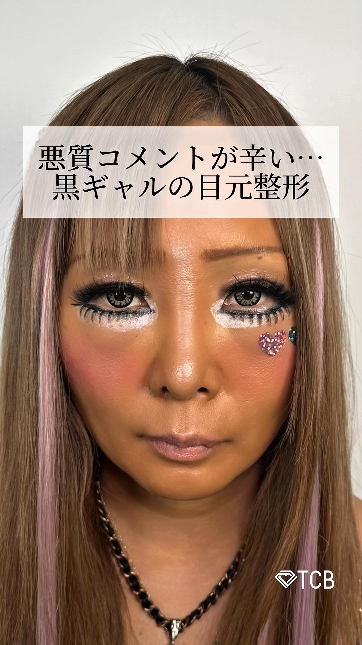 @【二重整形】TCB 新宿東口院ゆいこ先生/東京