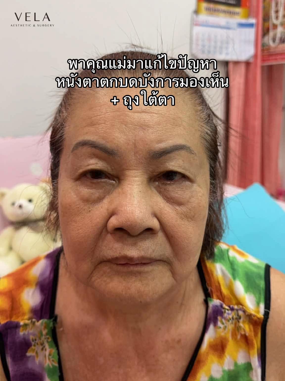 @เวลาคลินิก ตาสองชั้น ถุงใต้ตา