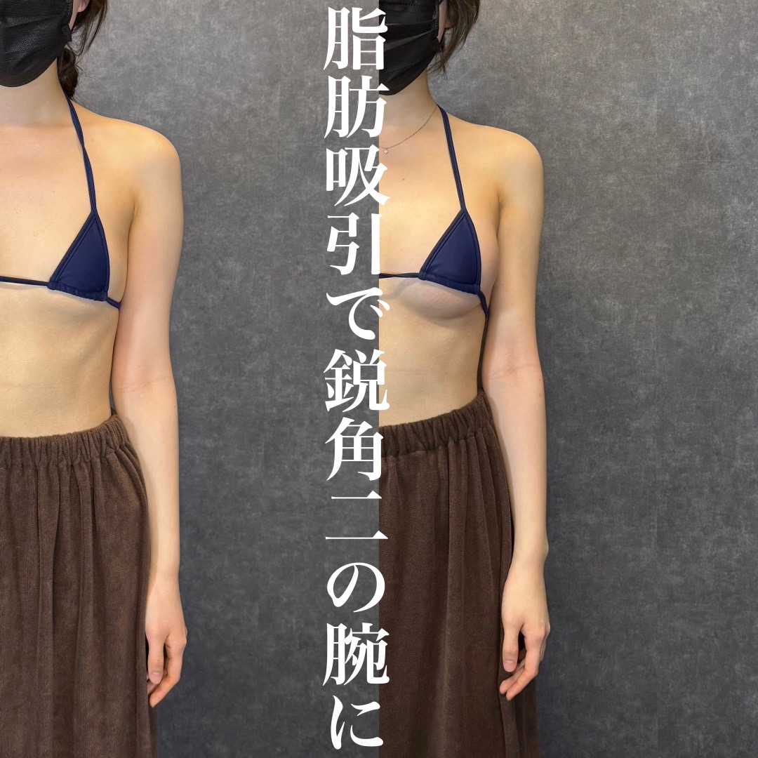 @SHIN/森脇 進の二の腕脂肪吸引・豊胸