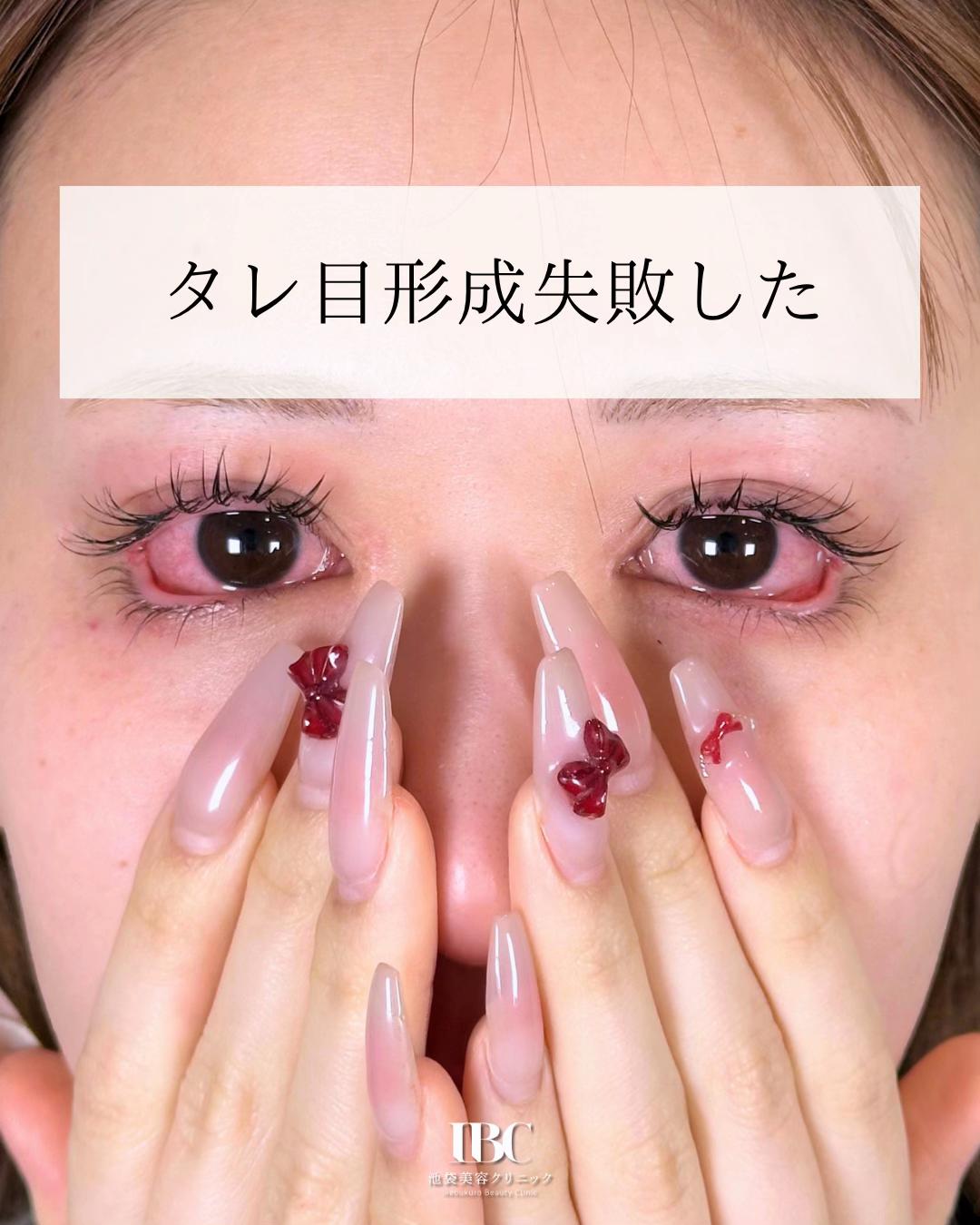 @高倉光平【タレ目形成×目尻切開】