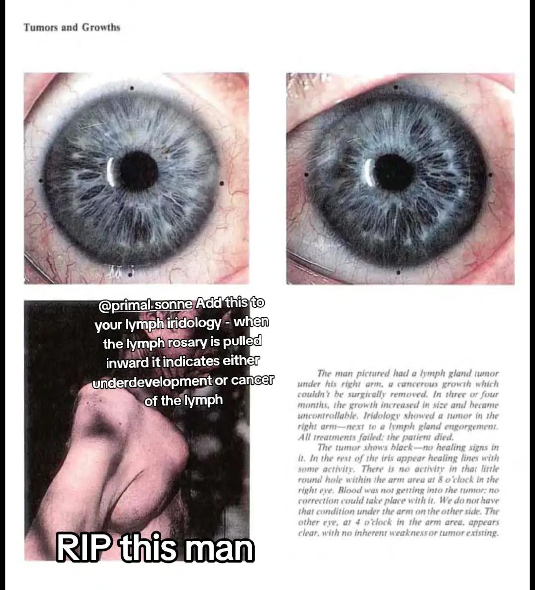 @Oliver | Aajonus' Iridology 👀