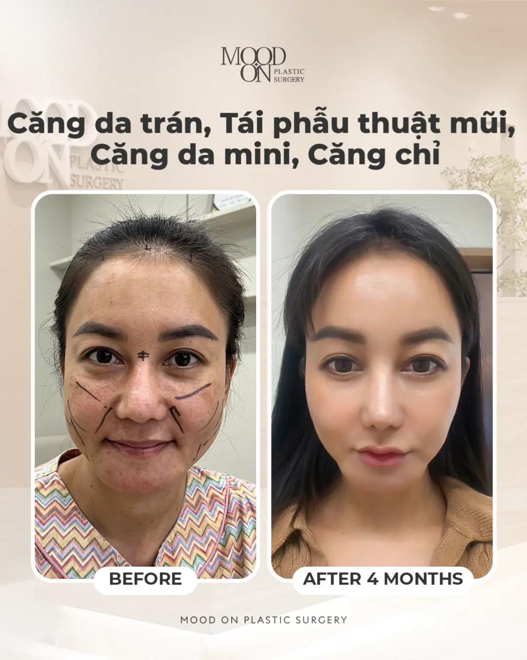 @Bệnh viện thẩm mỹ Mood On