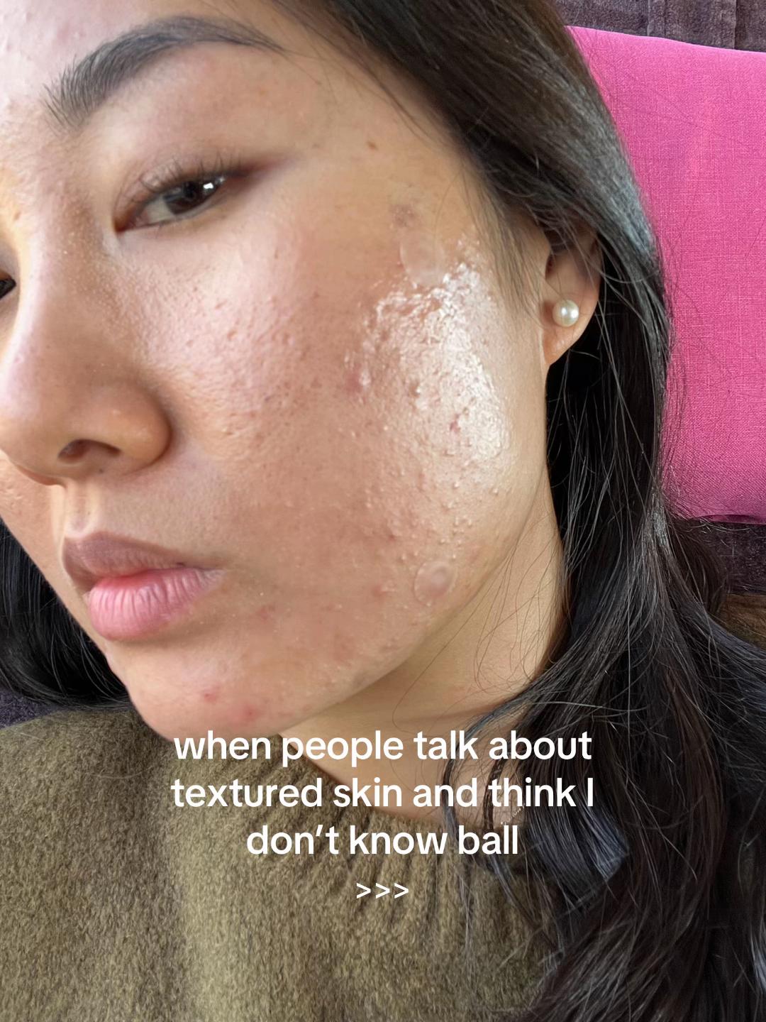 @Lisa | acne &rarr; clear skin