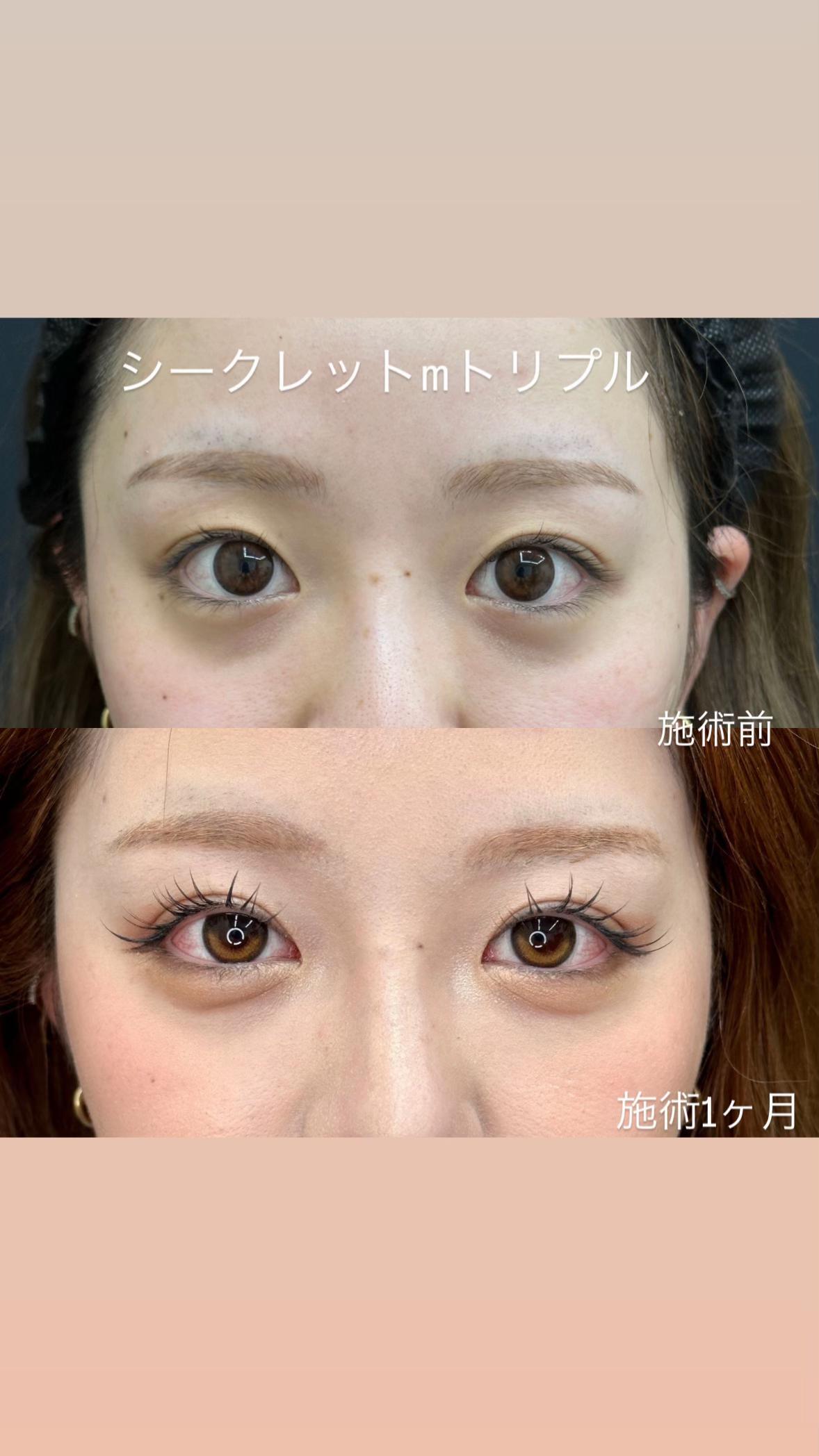 @二重整形埋没法/広島美容外科メイプルクリニック院長 吉本如良