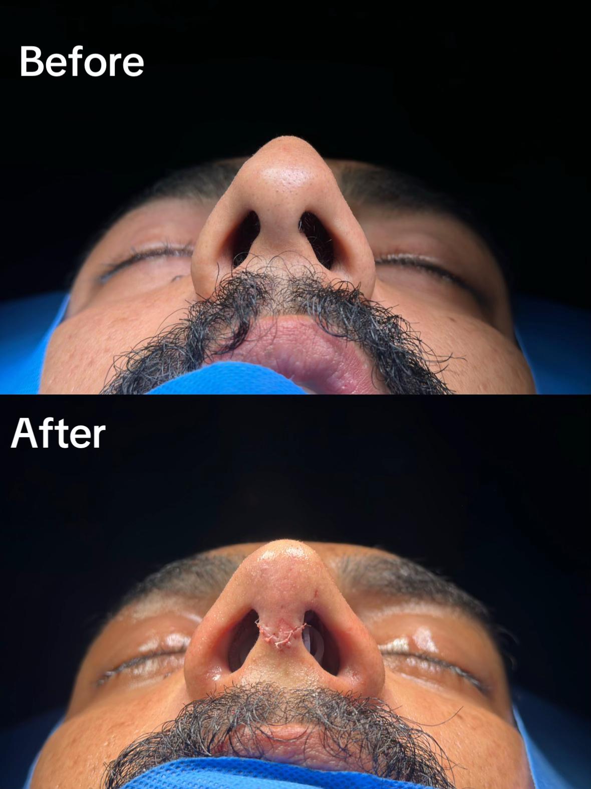 @Rhinoplastyhub clinic222