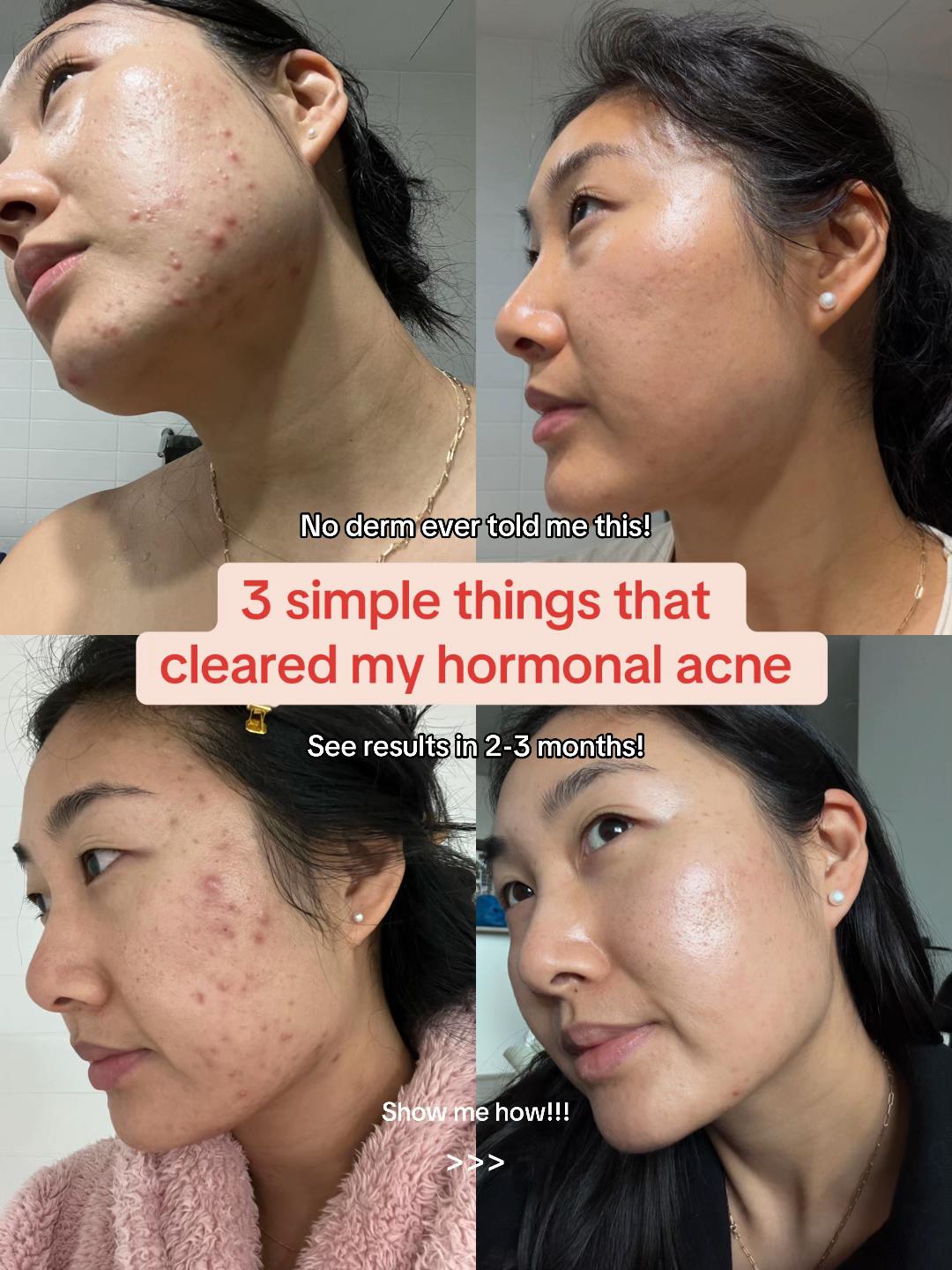 @Lisa | acne → clear skin