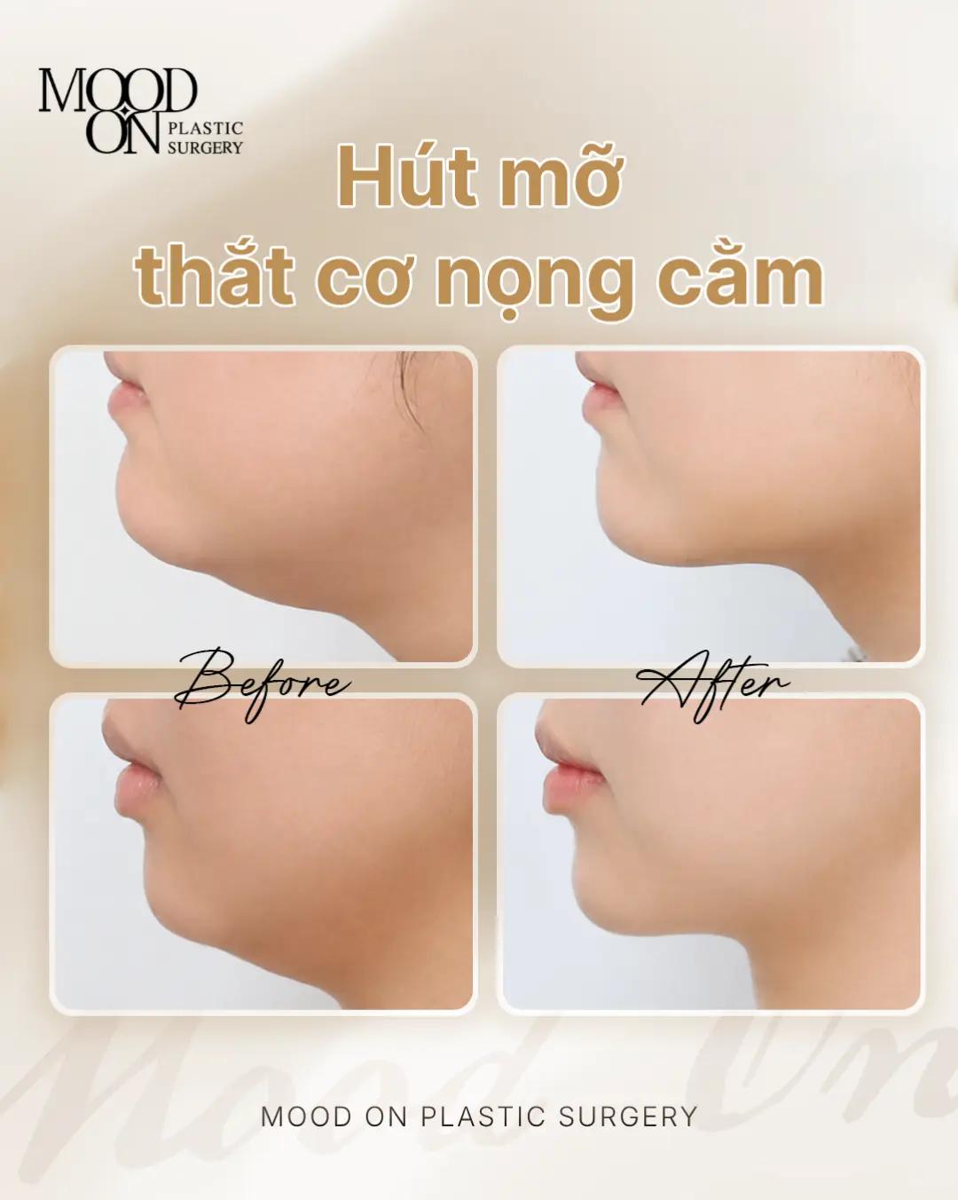 @Bệnh viện thẩm mỹ Mood On