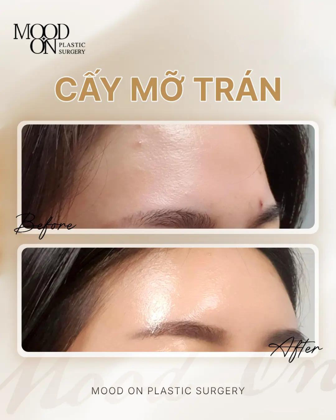 @Bệnh viện thẩm mỹ Mood On