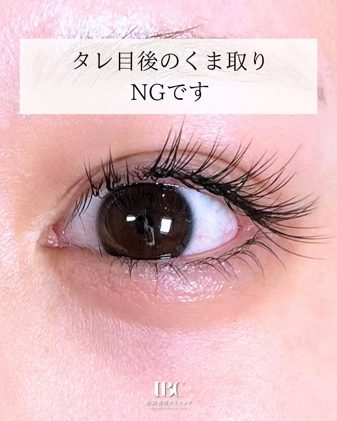 @高倉光平【タレ目形成×目尻切開】