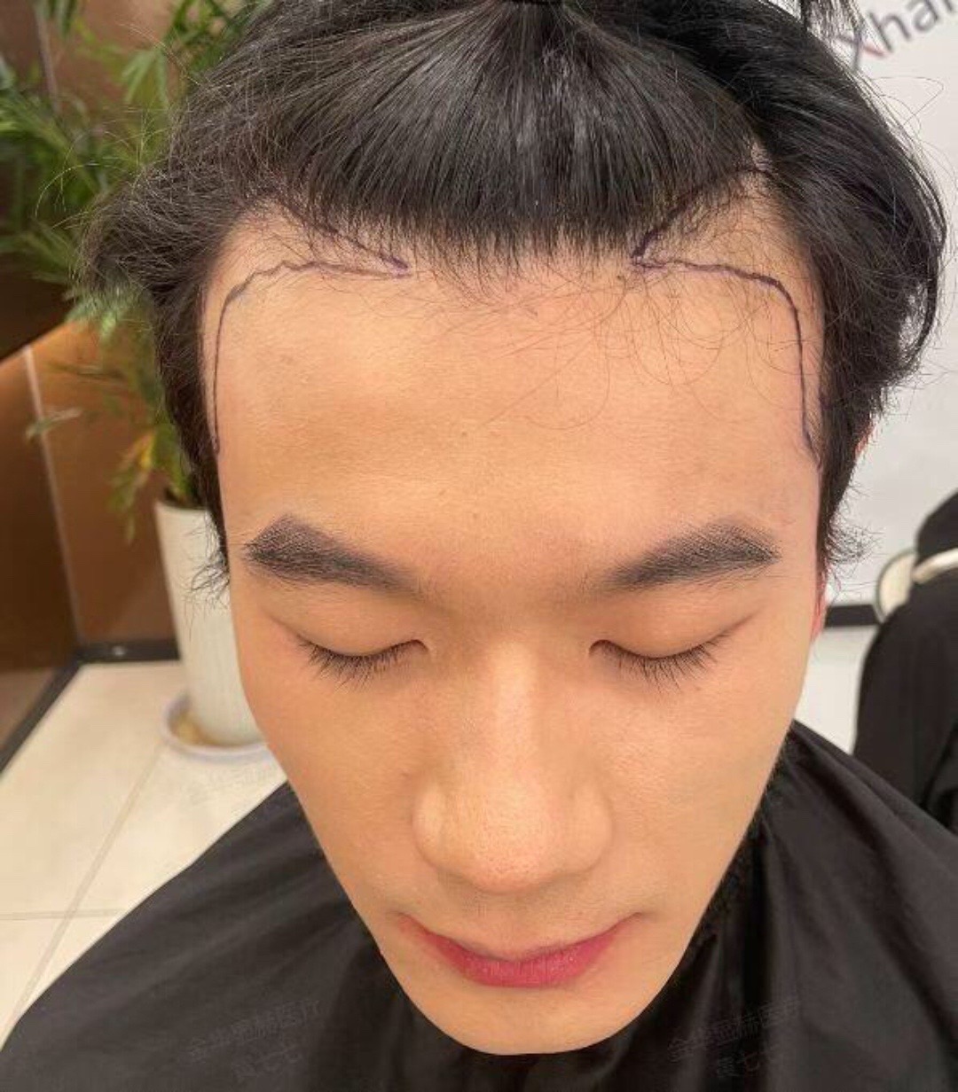 @HAIR TRANSPLANT WANG🇨🇳