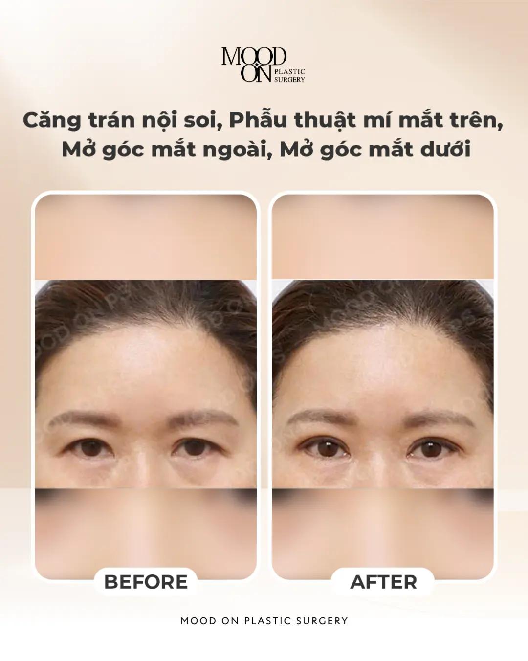 @Bệnh viện thẩm mỹ Mood On