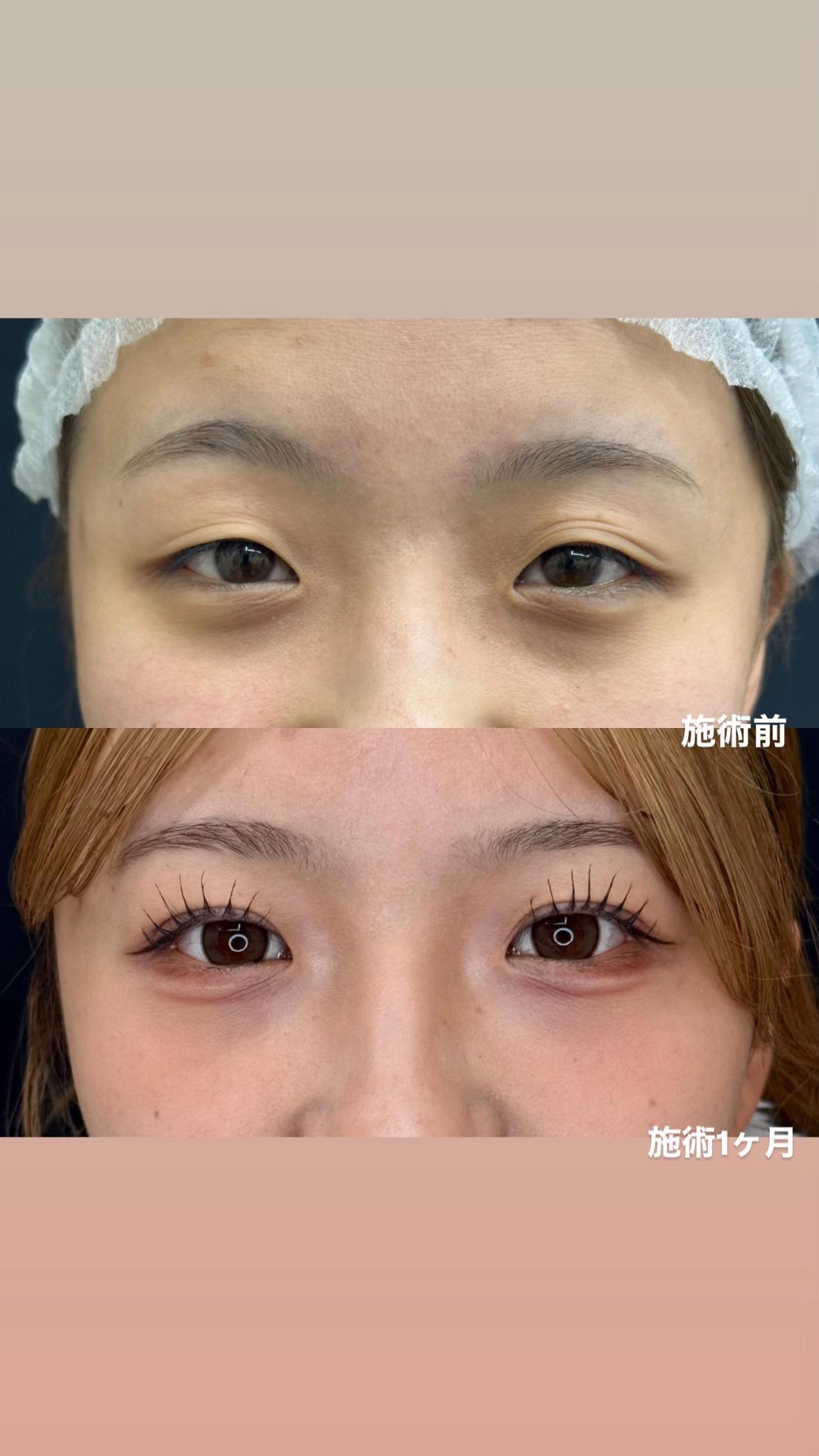 @二重整形埋没法/広島美容外科メイプルクリニック院長 吉本如良