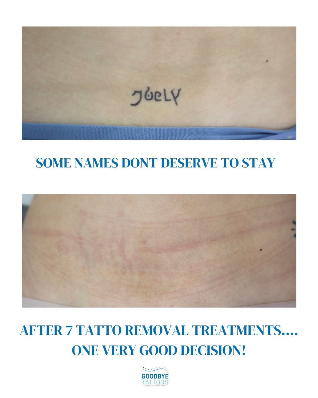 @Jamie T| Tattoo Removal Expert
