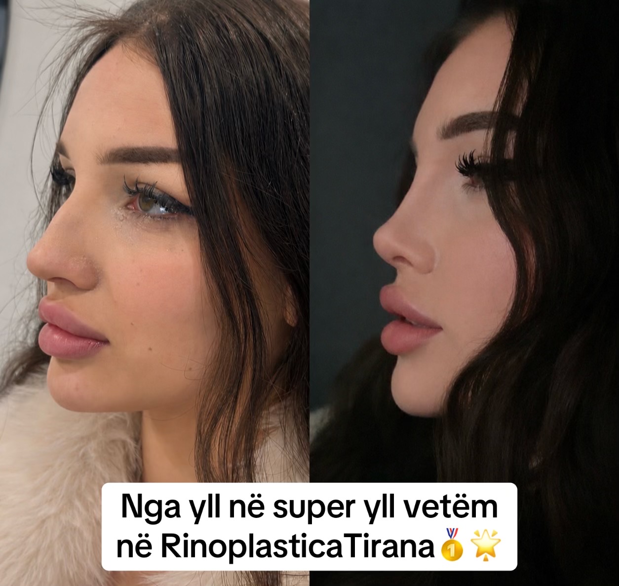 @rinoplasticatirana
