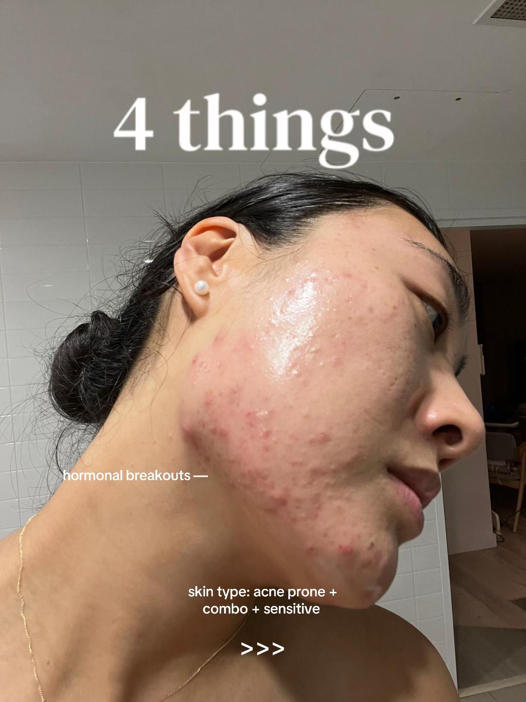 @Lisa | acne &rarr; clear skin