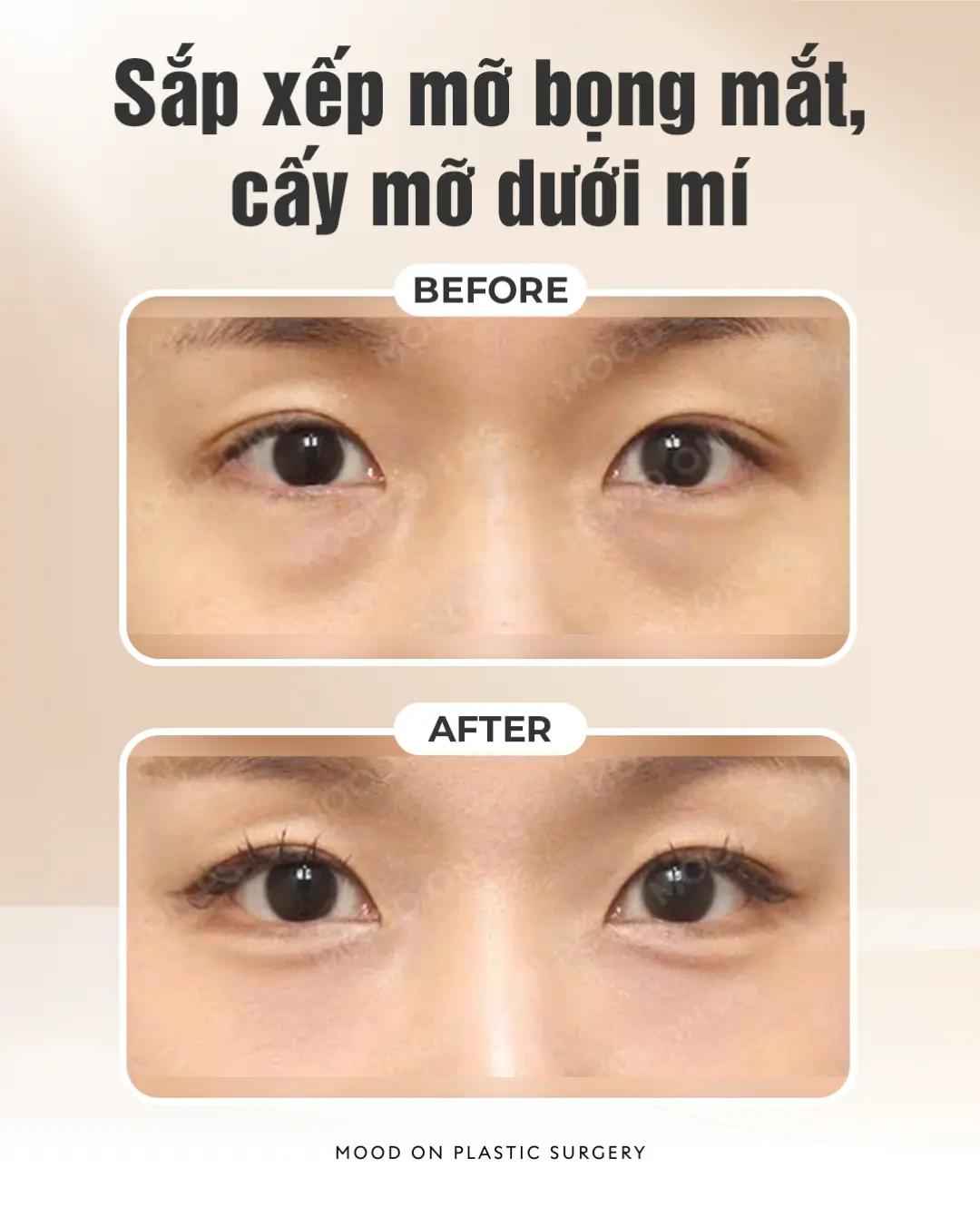 @Bệnh viện thẩm mỹ Mood On