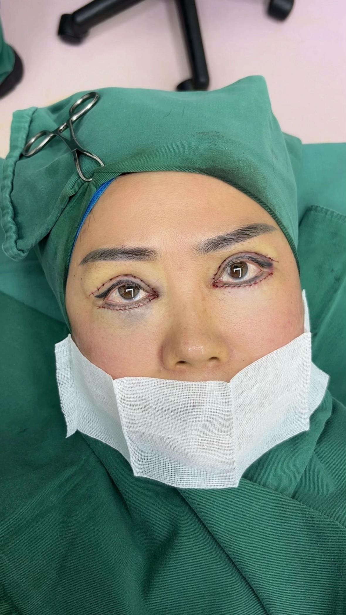 @Nose augmentation