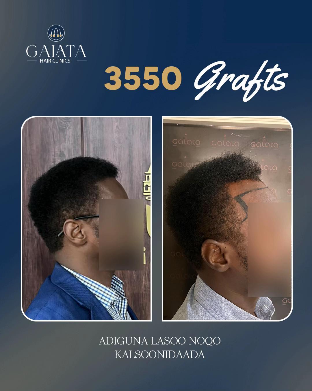 @galata_hair_clinic
