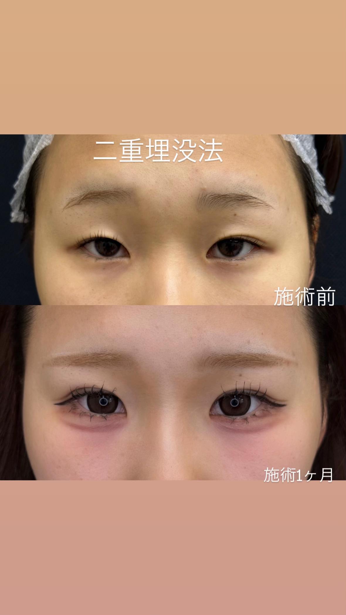 @二重整形埋没法/広島美容外科メイプルクリニック院長 吉本如良