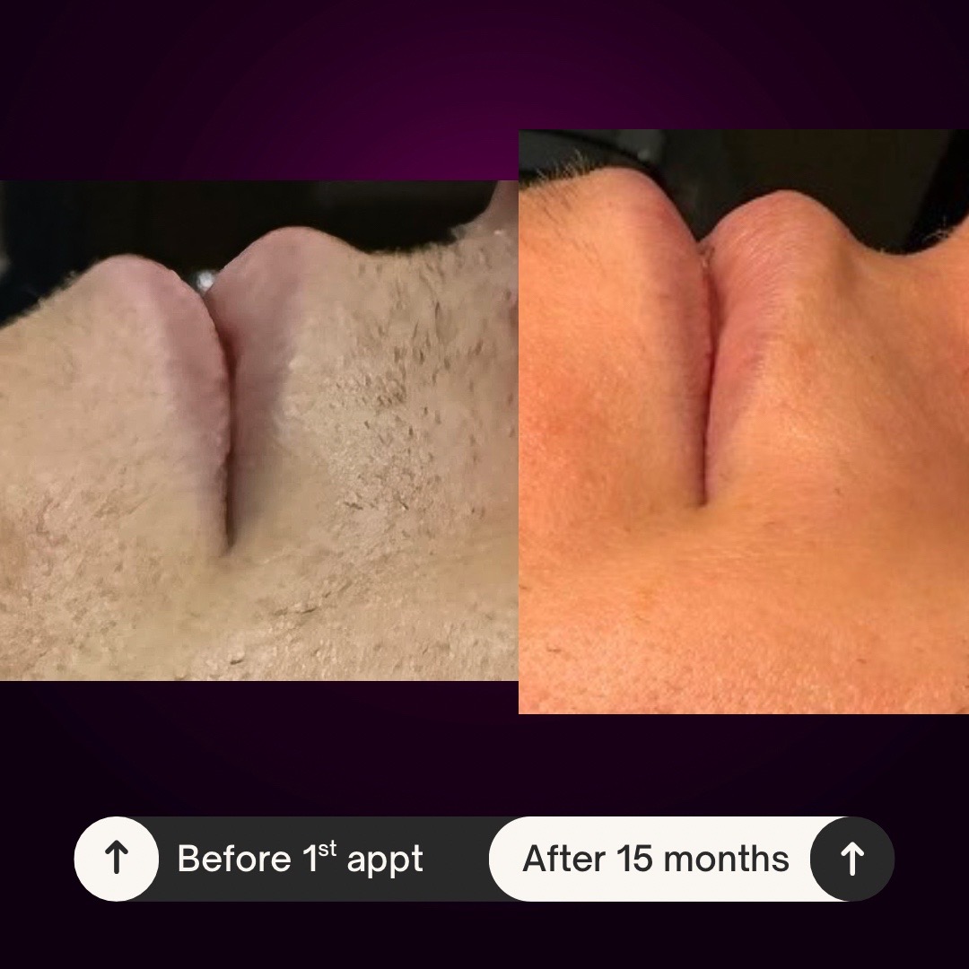 @Neurospice Beauty Electrolysis