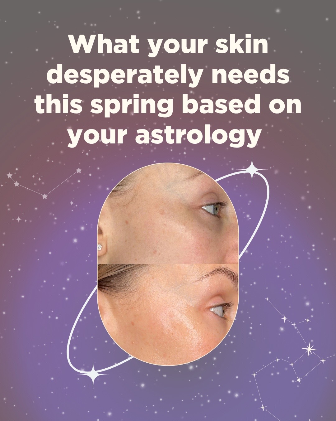 @Celeste | RN acne expert