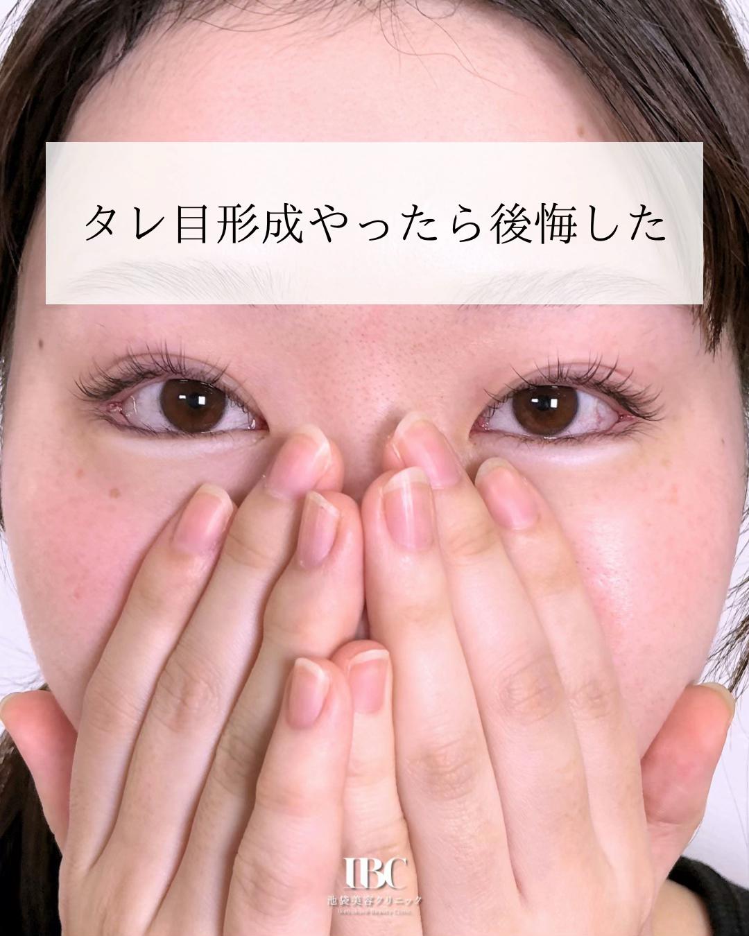 @高倉光平【タレ目形成×目尻切開】