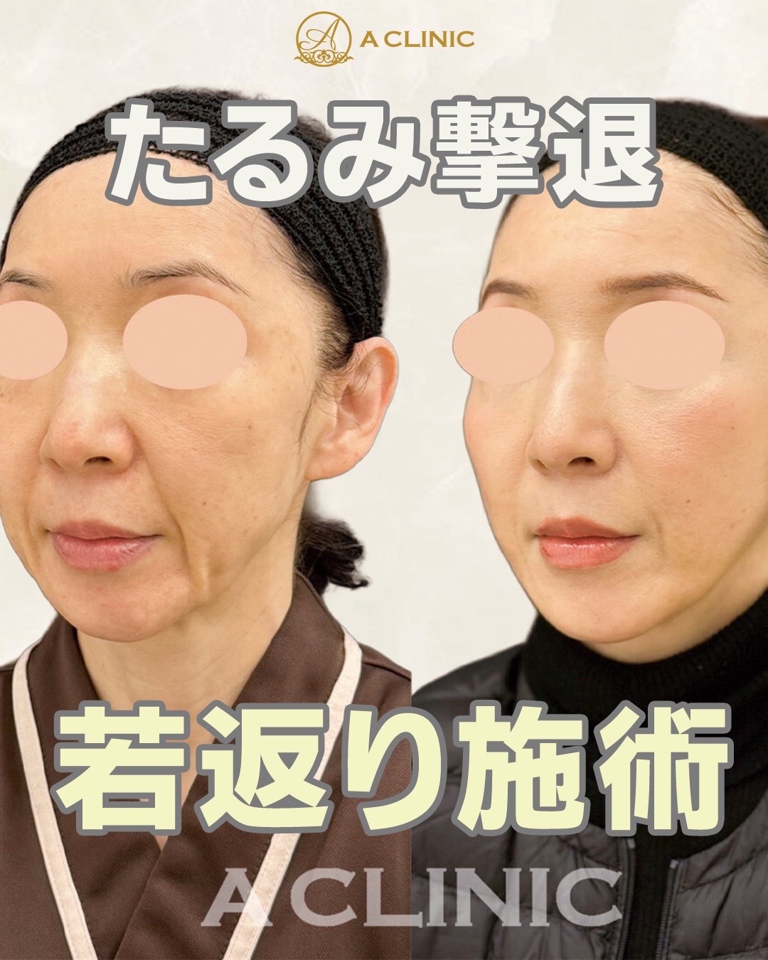 @ACLINIC池袋院【小顔/中顔面短縮】