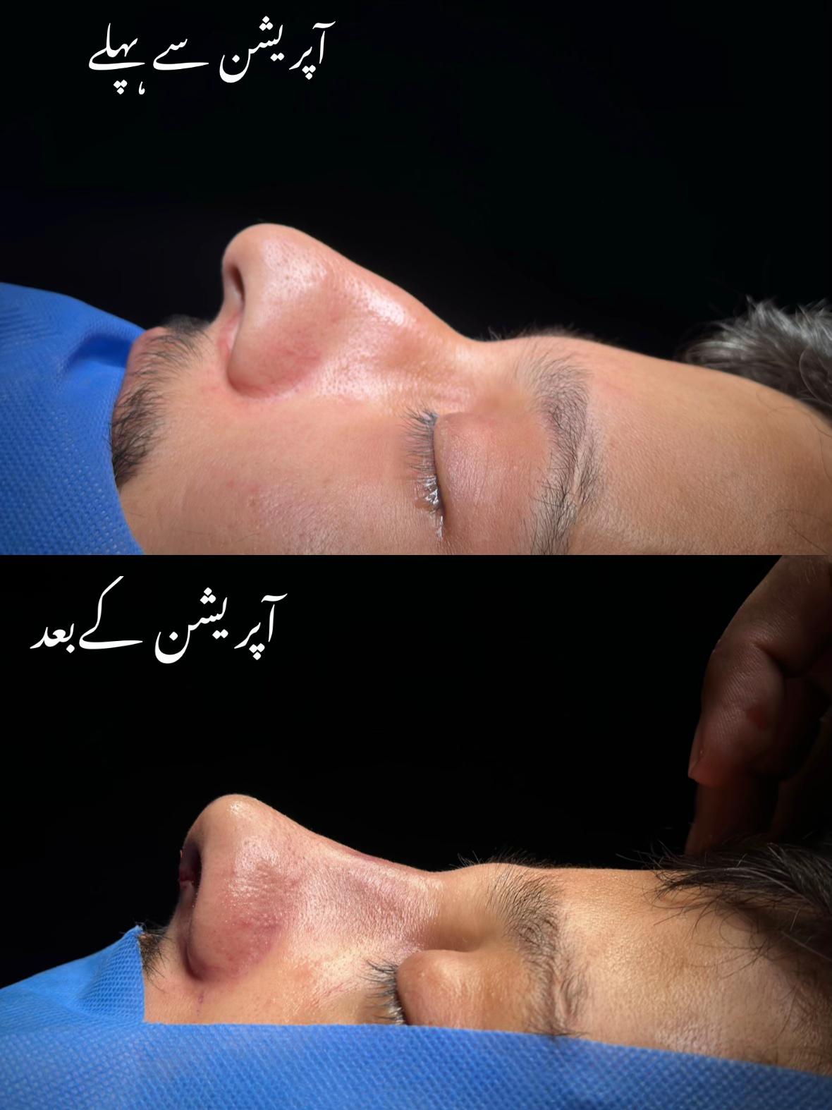 @Rhinoplastyhub clinic222