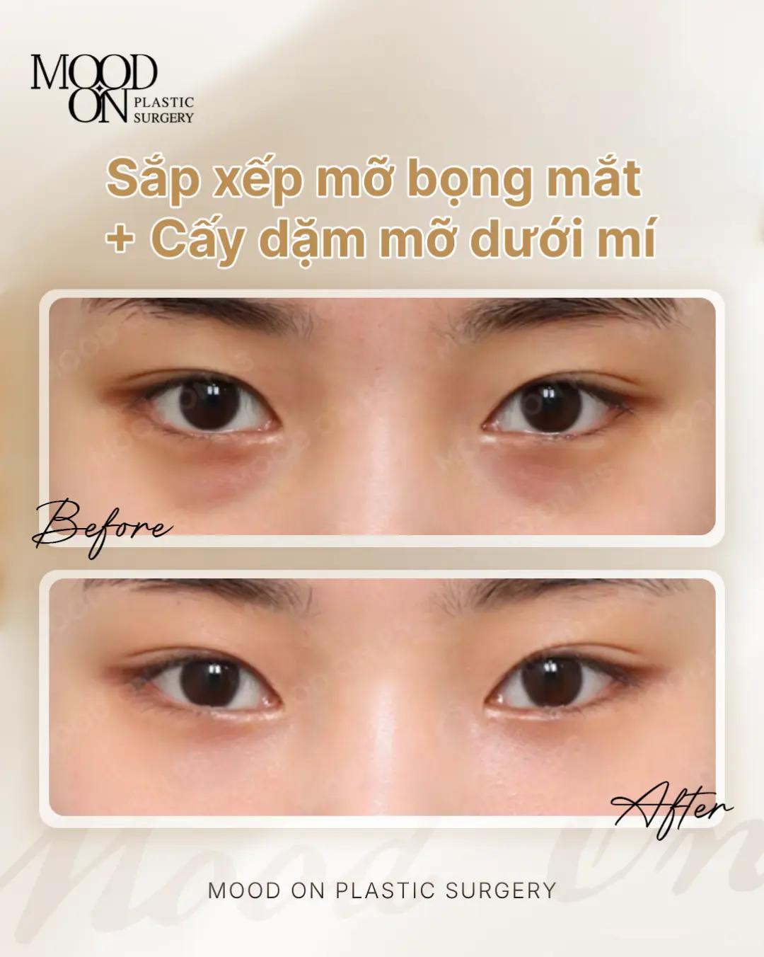 @Bệnh viện thẩm mỹ Mood On