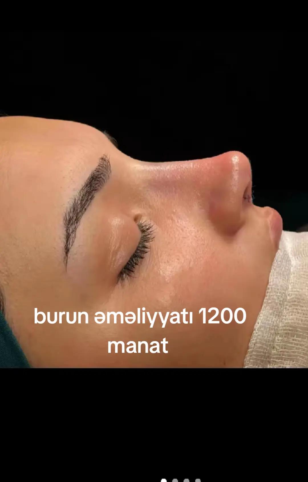 @rinoplastika_lor.dr.resad