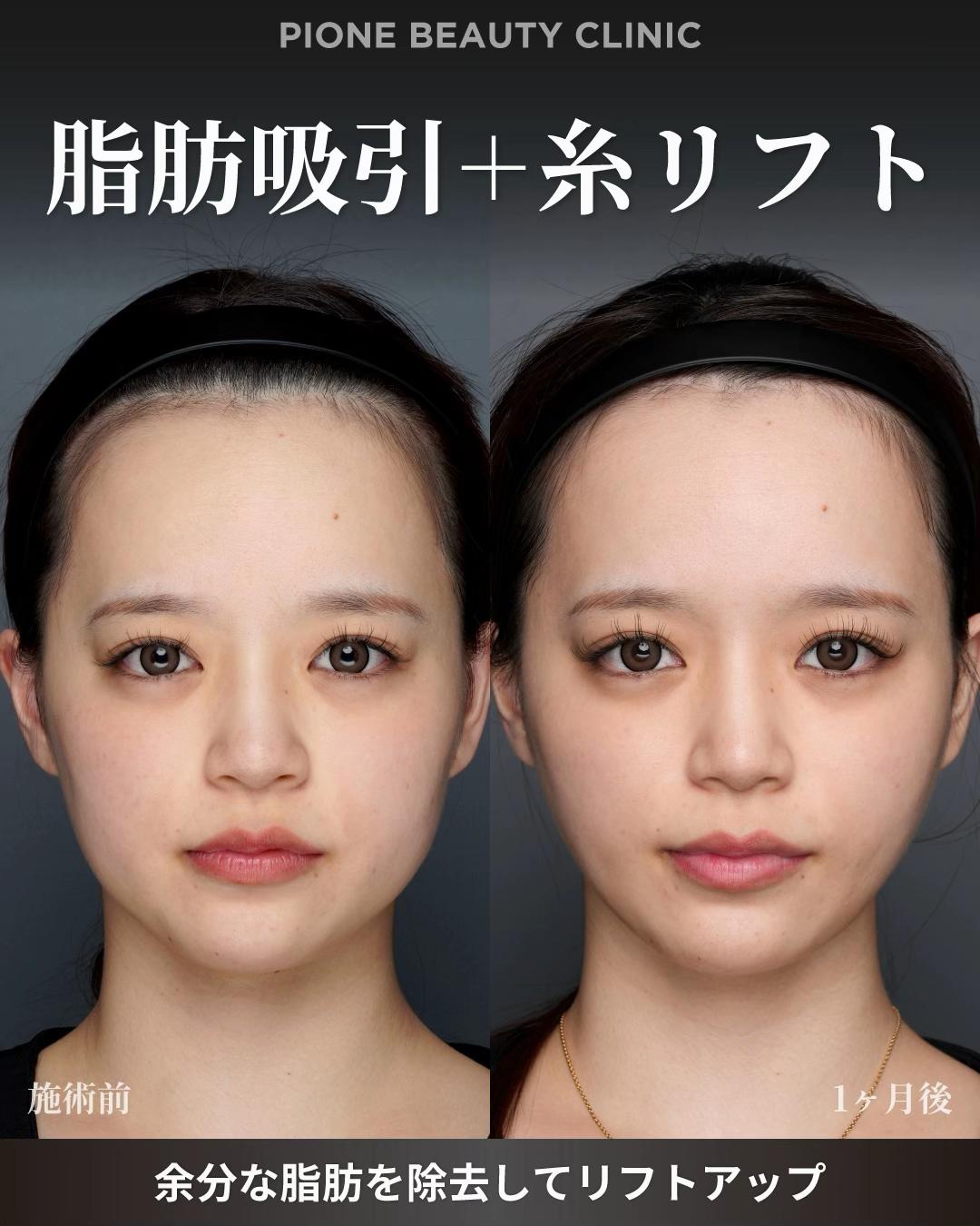 @金澤紀臣【小顔/若返り/脂肪吸引】