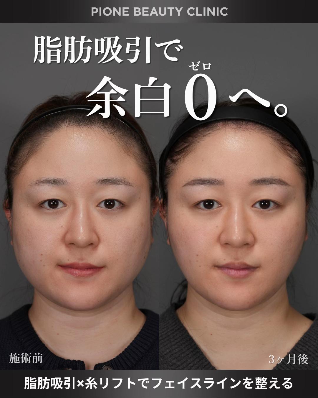 @金澤紀臣【小顔/若返り/脂肪吸引】