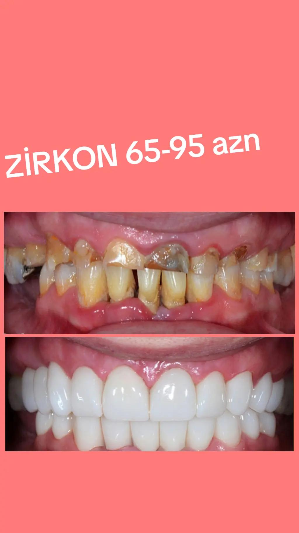 @implant.32
