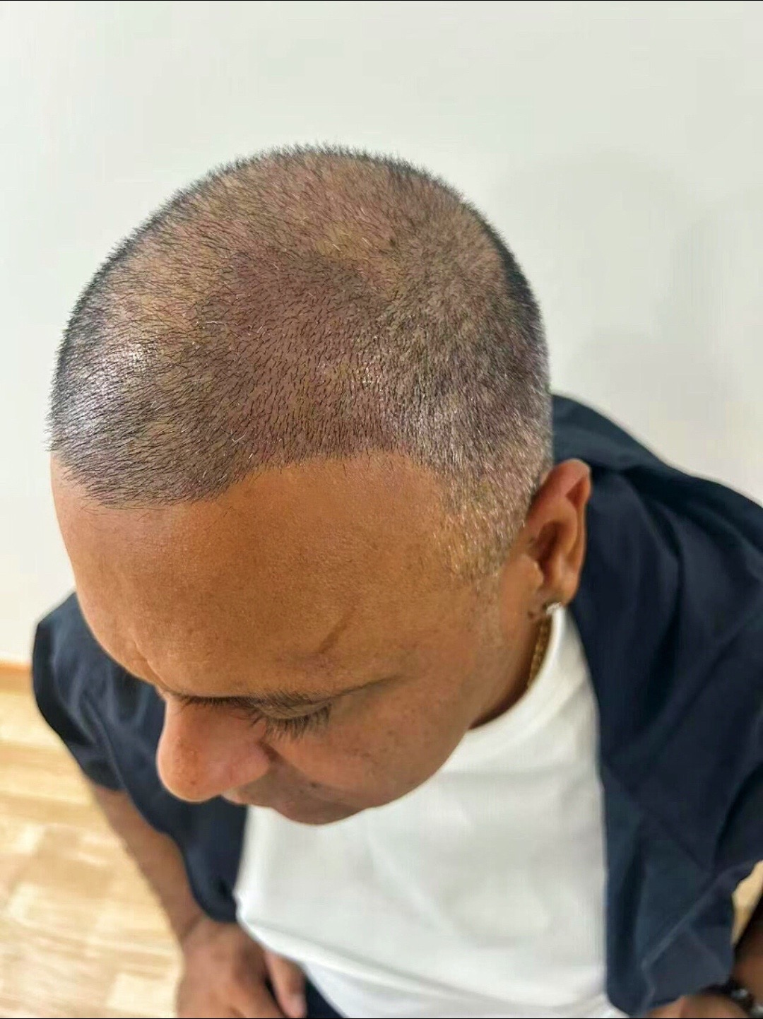 @HAIR TRANSPLANT WANG🇨🇳