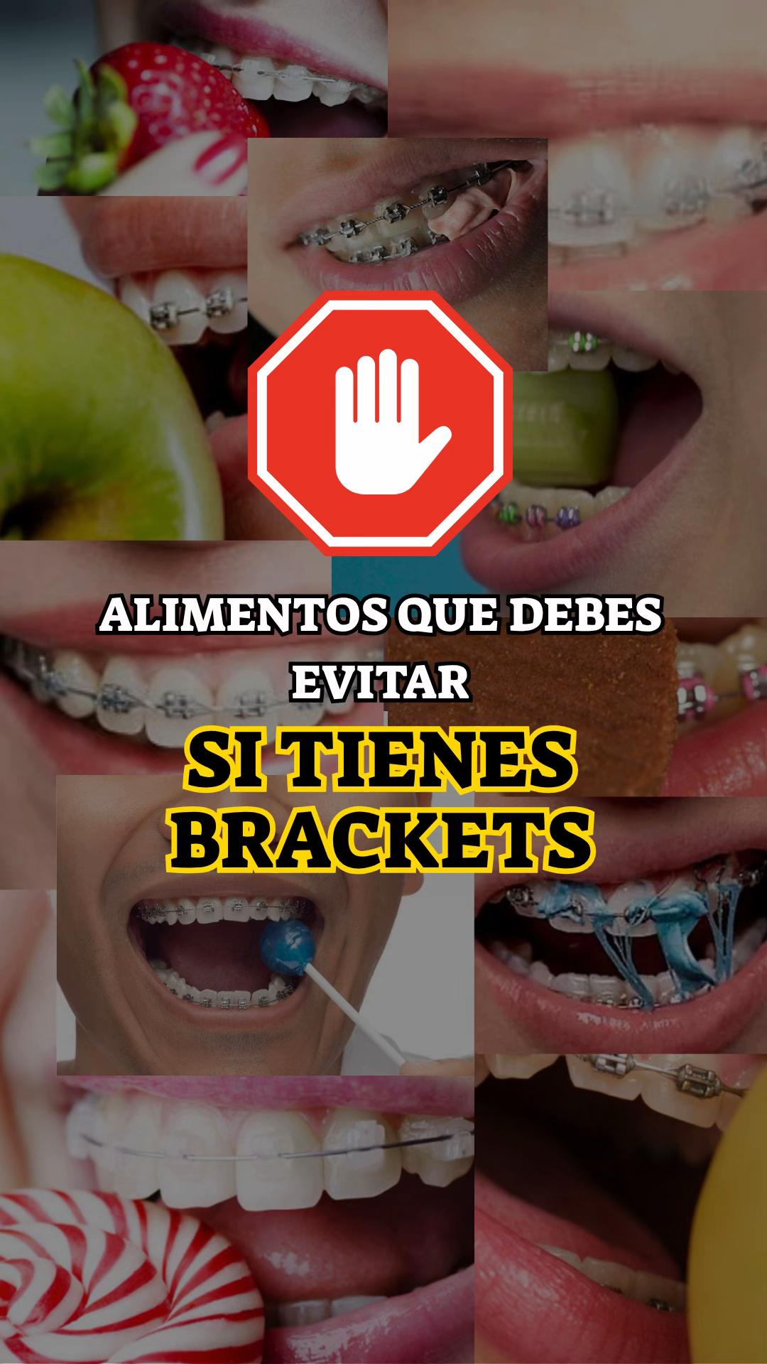 @Brackets y Alineadores