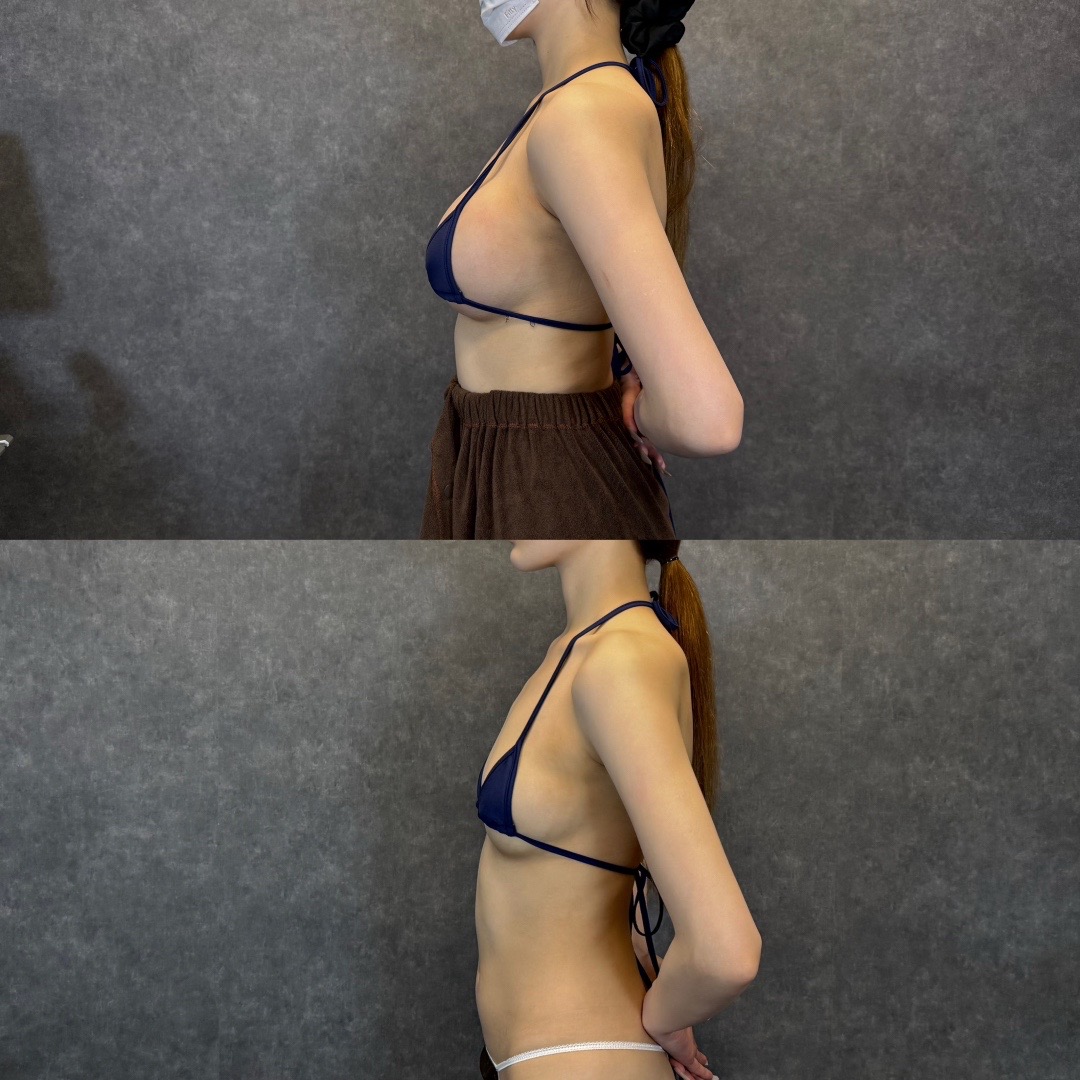 @SHIN/森脇 進の二の腕脂肪吸引・豊胸