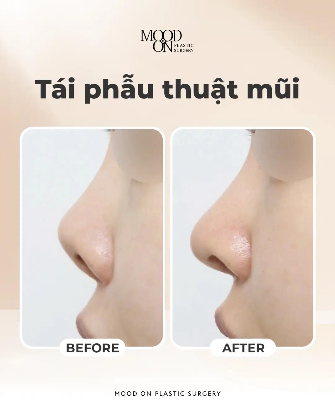 @Bệnh viện thẩm mỹ Mood On