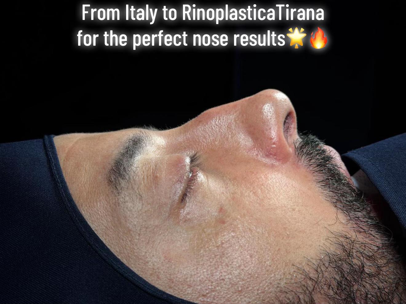 @rinoplasticatirana