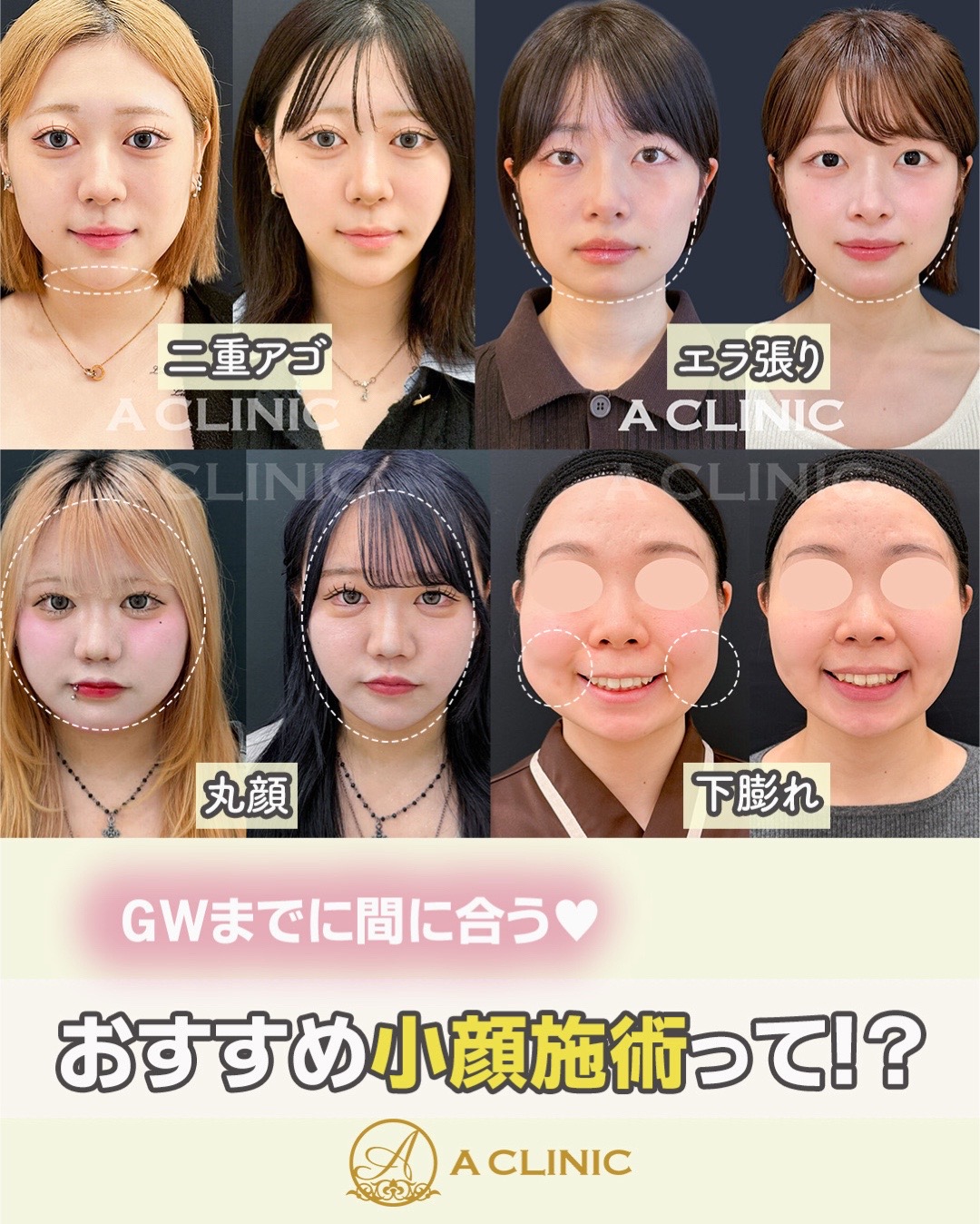 @ACLINIC池袋院【小顔/中顔面短縮】