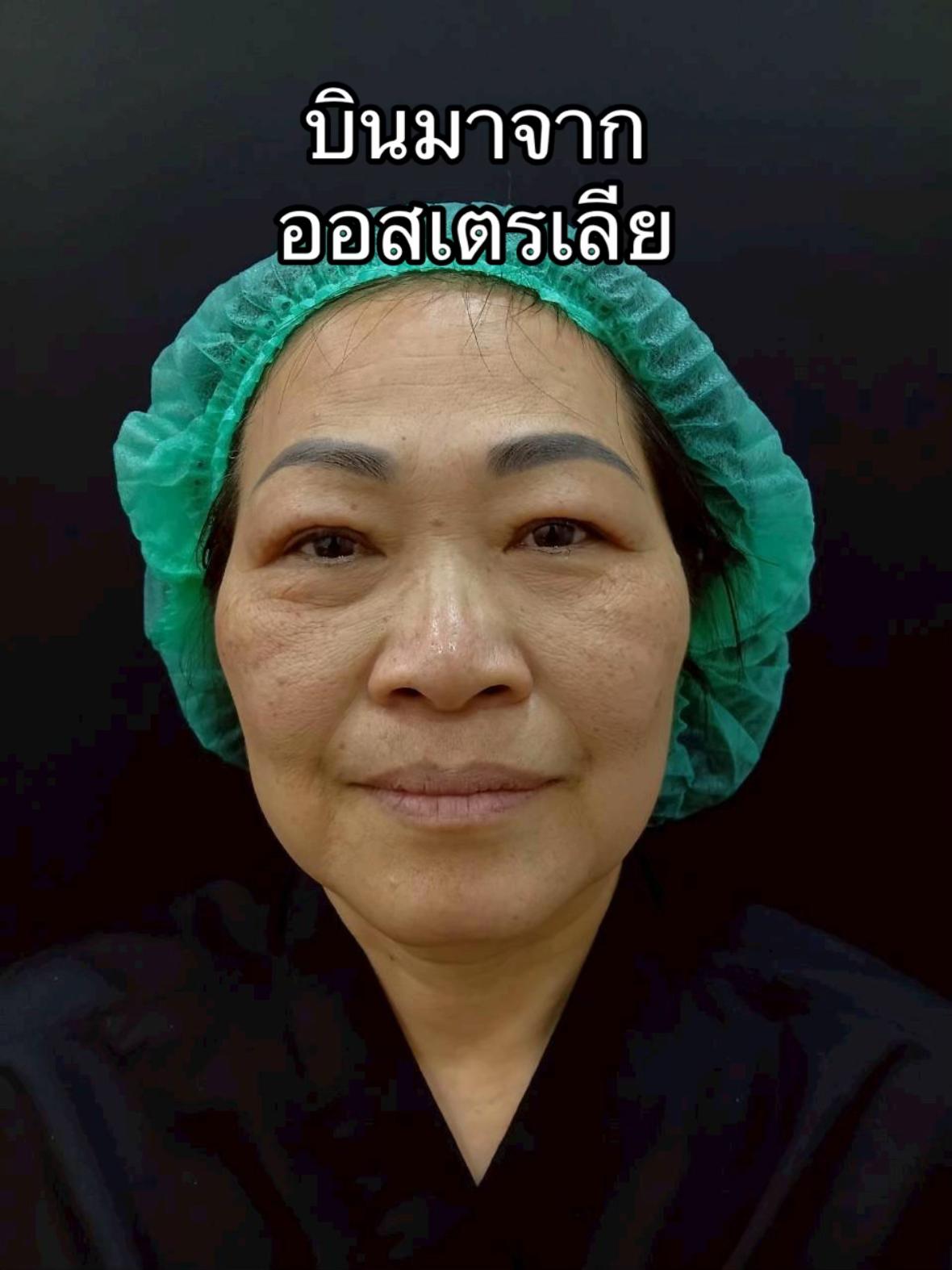 @ดึงหน้า ud clinic