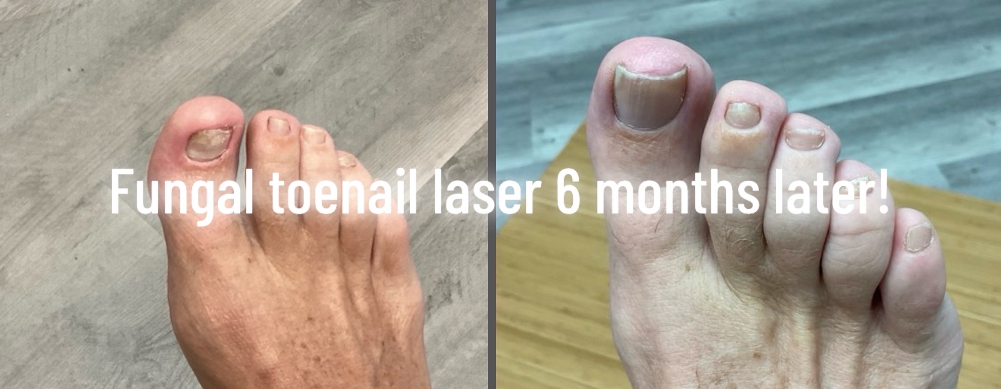 @The Bunion Boss