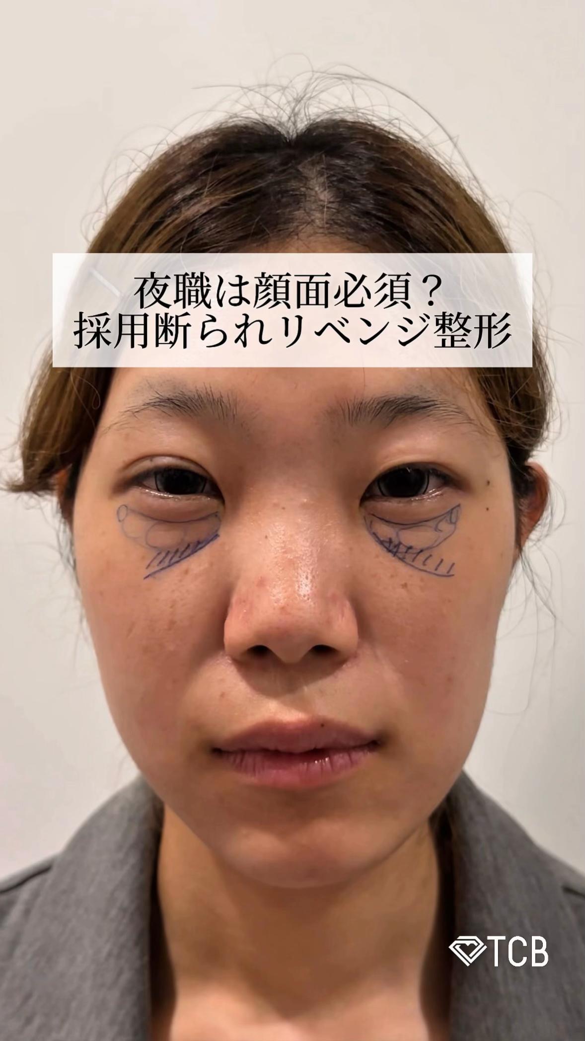 @【二重整形】TCB 新宿東口院ゆいこ先生/東京