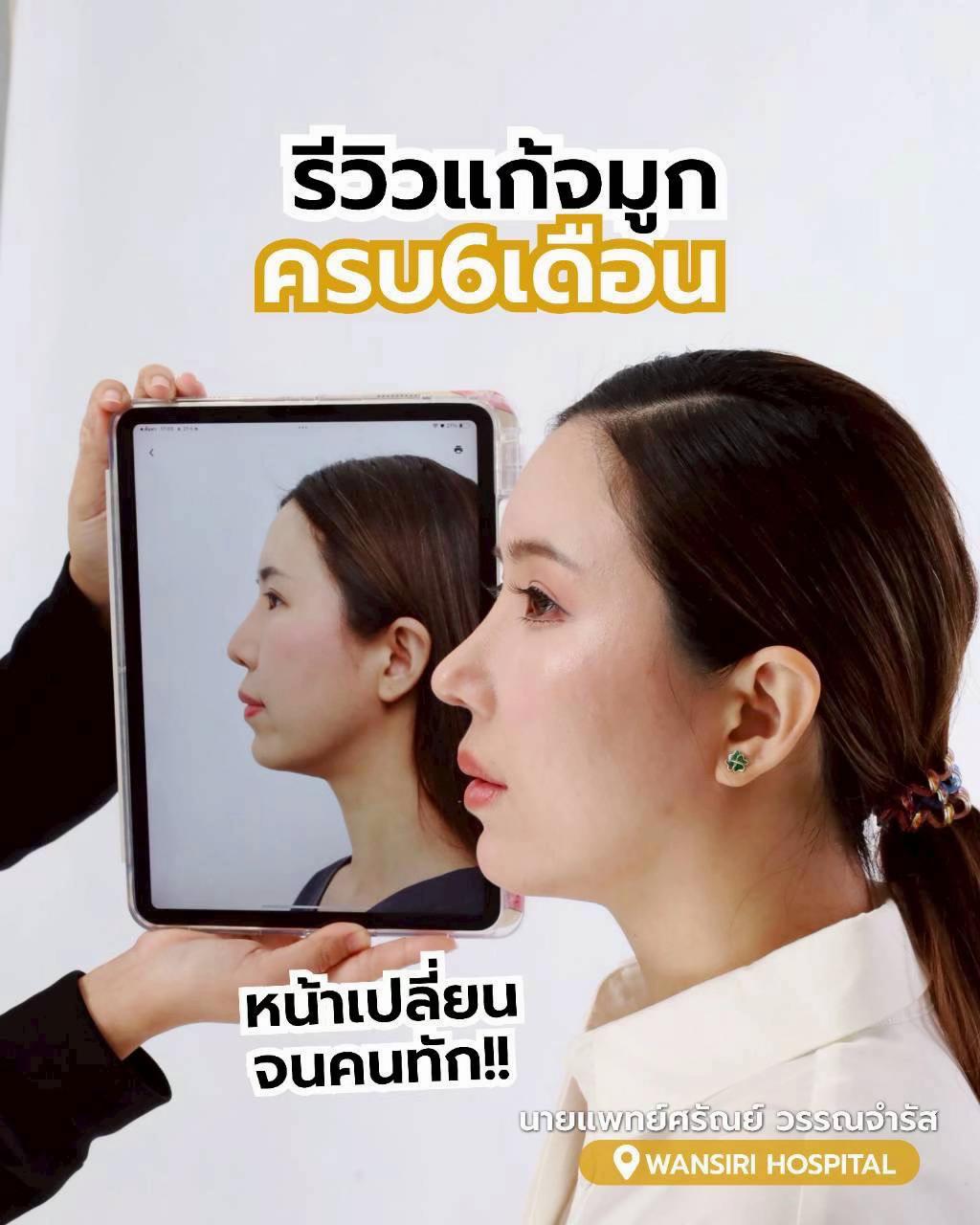 @หมอป่องสวยมาก veneer 🦷