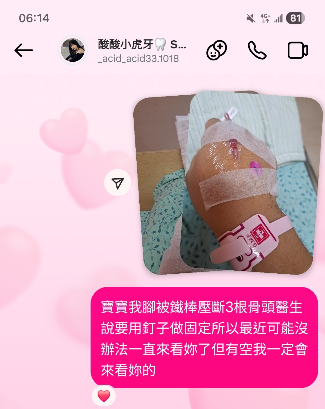 @˚ᝰᩚ꯭˚酸酸ᘜ峰峰ഒᩚ࿐（酸酸小虎牙🦷）