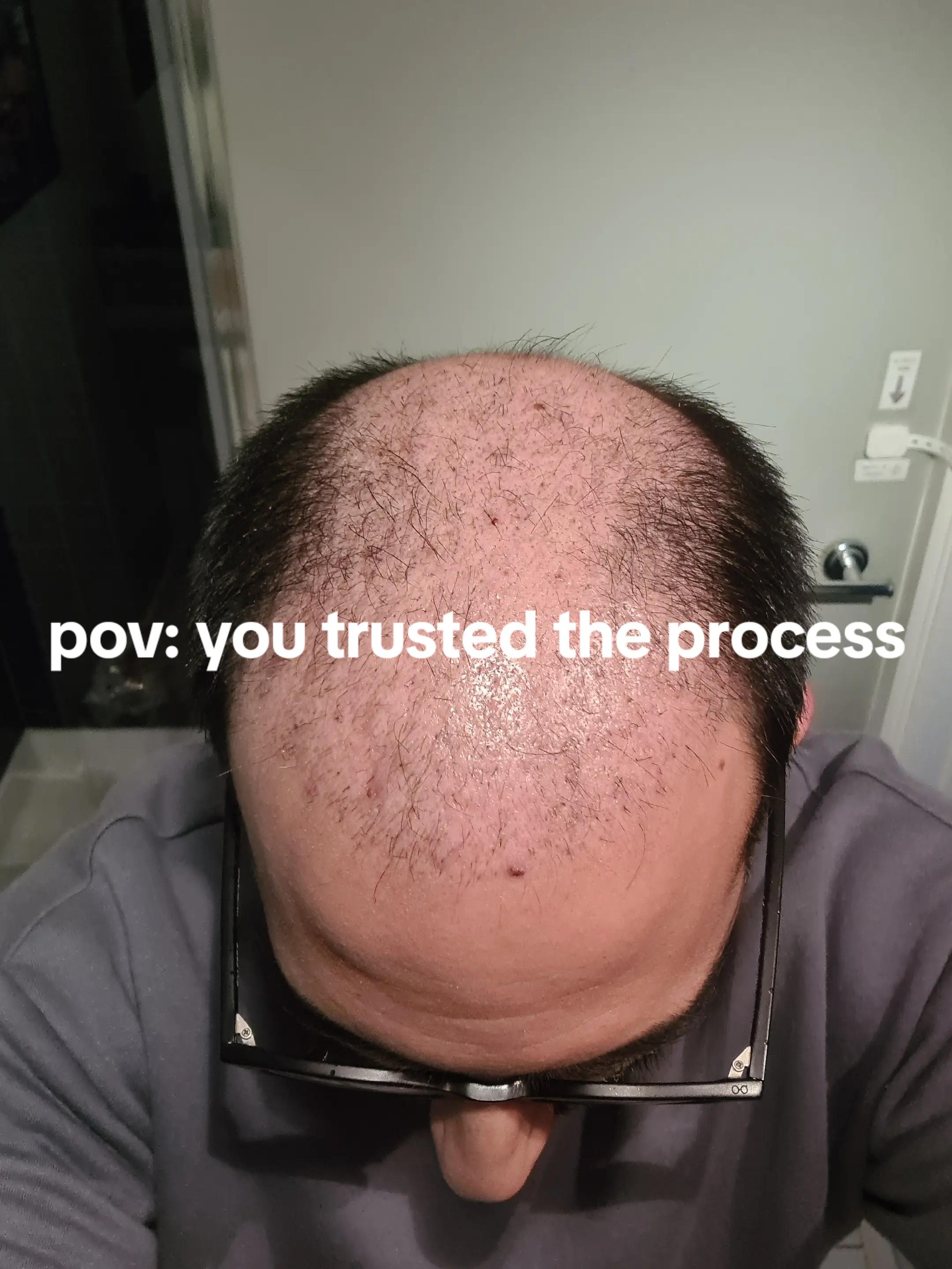@Amit | Hair Transplant Tips