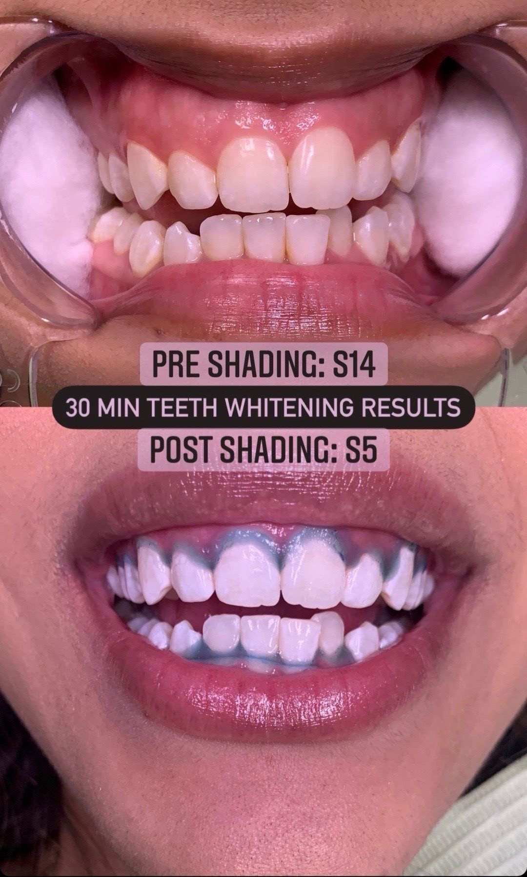 @Diandra | Teeth Whitening Tech