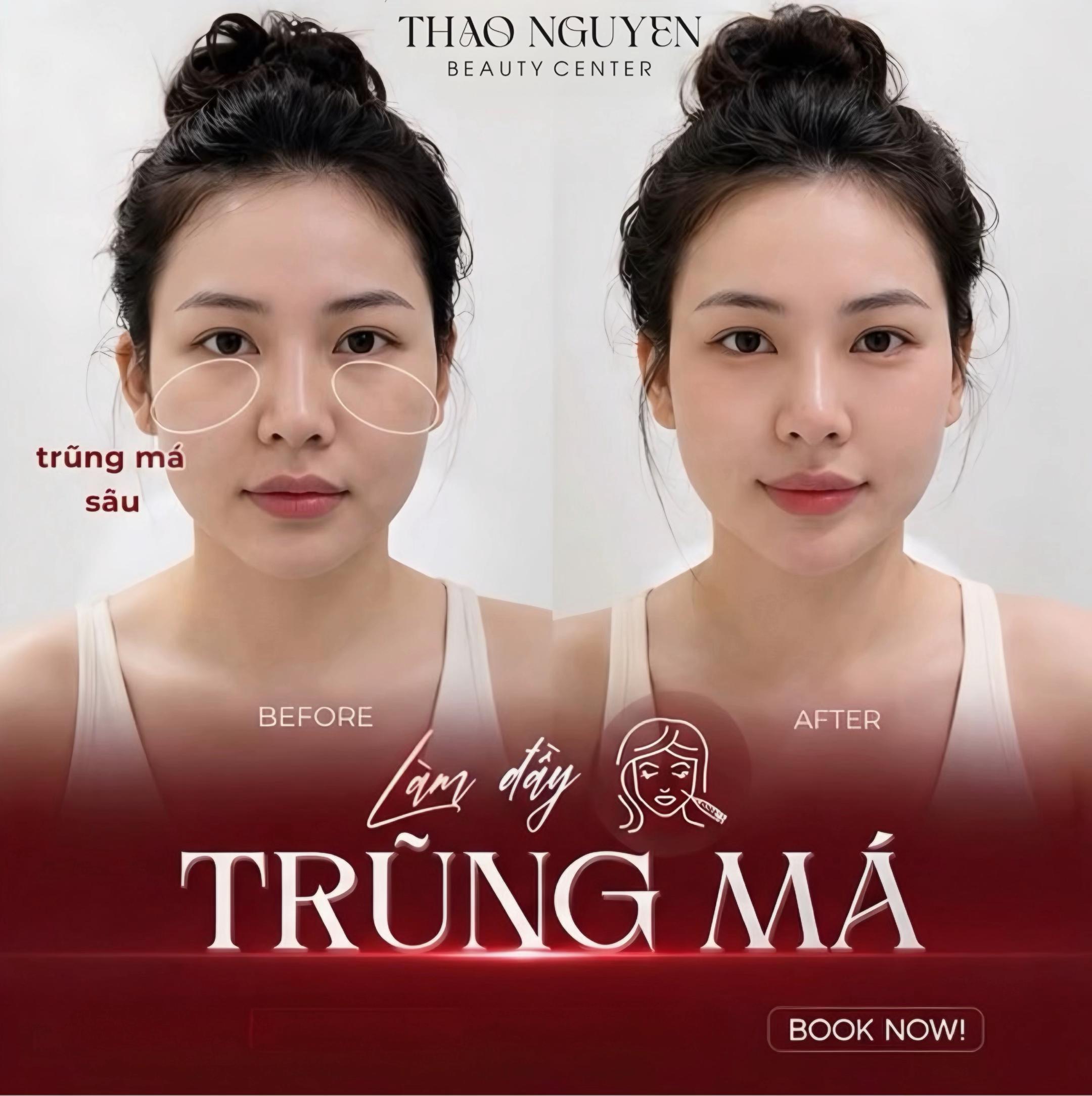 @TN - Filler Botox Đà Nẵng