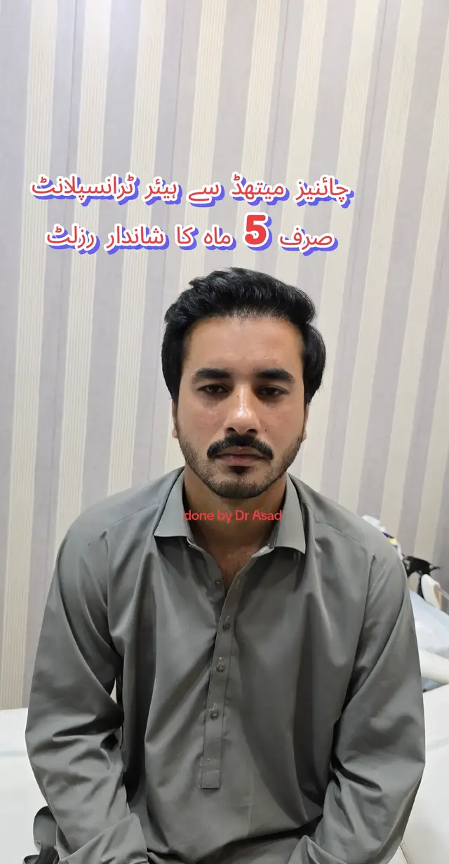 @Dr Asad shalman HairTransplant